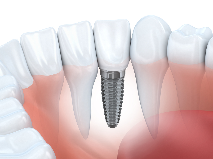 Somerville Dental Implants